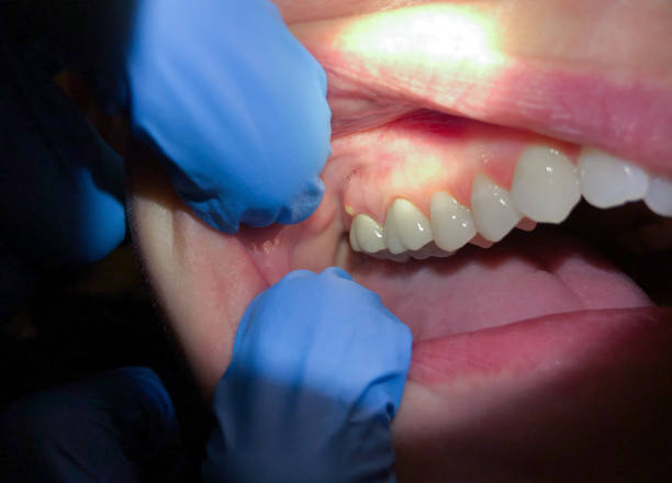 Best Emergency Treatment for Dental Infections or Abscesses in Alba, NY
